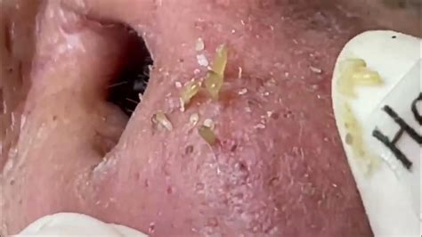 blackhead removal - youtube|newest blackhead removal videos.